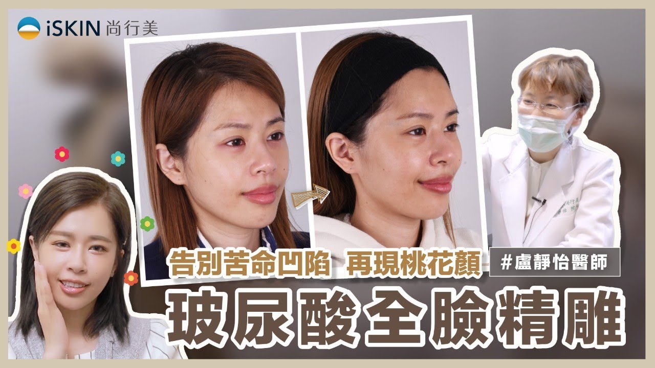 【玻尿酸全臉精雕】告別苦命凹陷，再現桃花顏！│盧靜怡院長