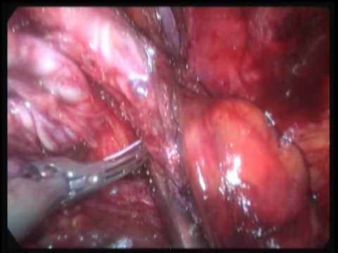 I tassi di intervento chirurgico alla prostata Cicatrice di prostata