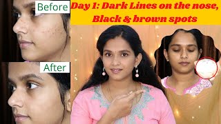 Day 1-Skin Care || Remove dark lines on the nose, Dark & Brown spots, Age spots || 100% natural