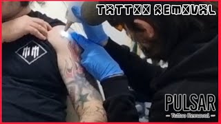 Tattoo Laser Removal in Redcar - What to Expect #lasertattooremoval #tattooremoval #redcar