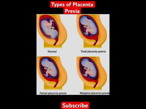 Types of Placenta Previa | #obg #obgynlife  #obgynteaching #obgmcq
