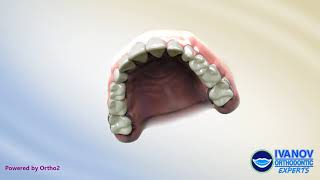 Pendulum Appliance Helps Move Molars