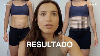 RESULTADO da BARRIGA pós 7 dias de ABDOMINOPLASTIA, recuperação e papo sobre a vida