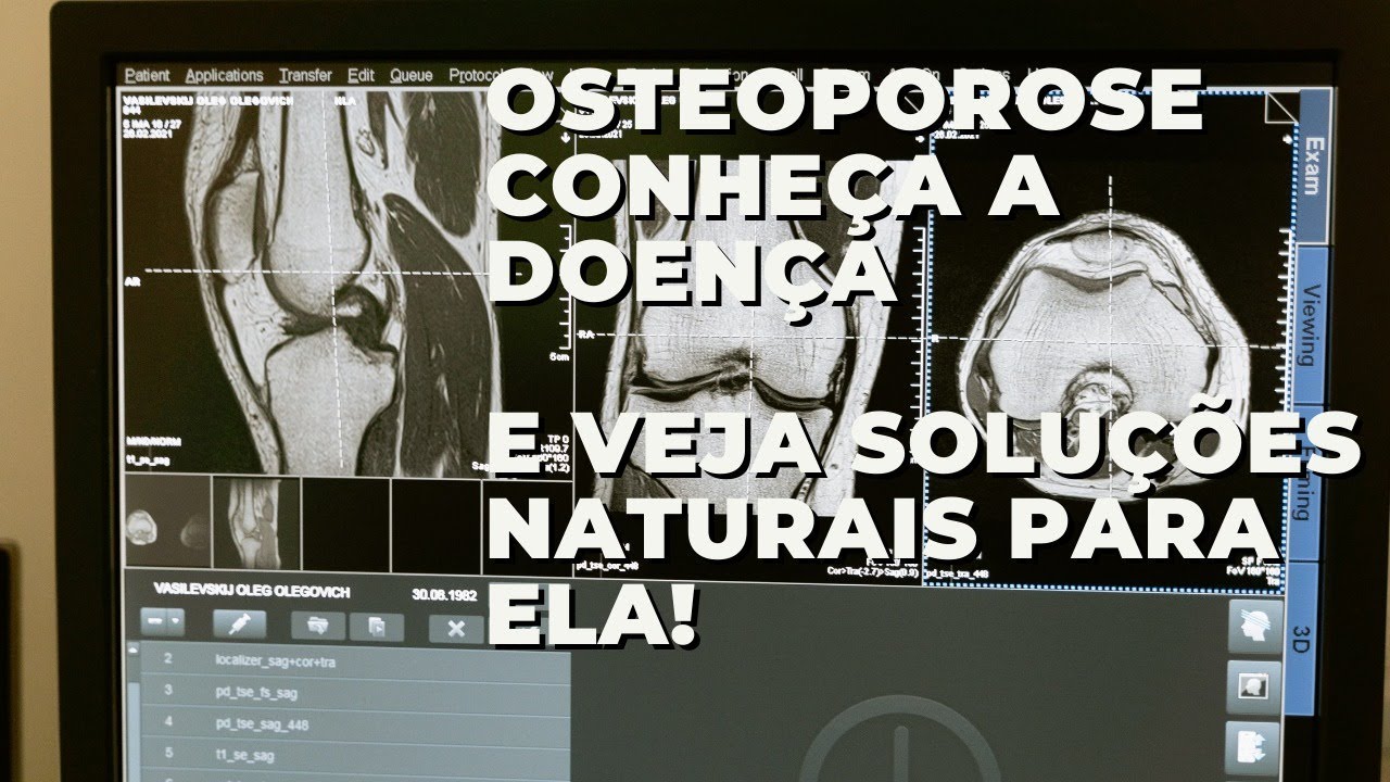 A verdadeira causa da osteoporose! E as soluções!