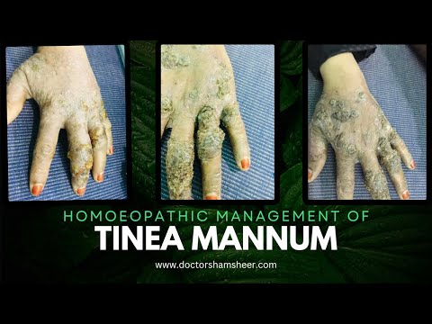 Tinea manuum-took 1 Month to cure
