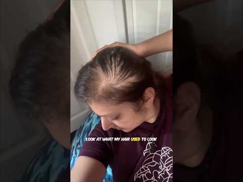 One serum Zero drama shocking results - the best hair growth serum in India 2025