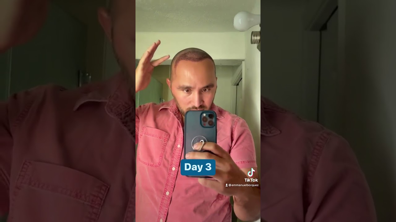 Amazing Hair Transplant Progress: Emmanuel's Transformation!