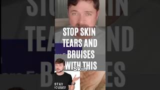 Heal Skin Tears And Bruises With This Simple Trick