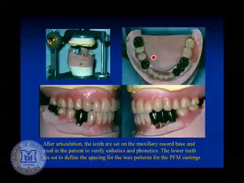 Tooth Supported Overdentures