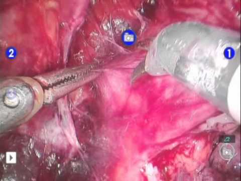 Robotic-Assisted Laparoscopic Radical Prostatectomy (RALRP) - Periurethral Suspension