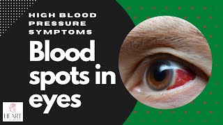 Is a blood spot in eye a symptom of high blood pressure? | Is a blood shot related to hypertension?