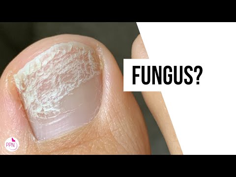 How to Remove White Marks on the Toenails