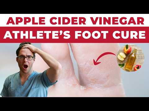 Athlete's Foot Fungus Cure [Apple Cider Vinegar Treatment!]