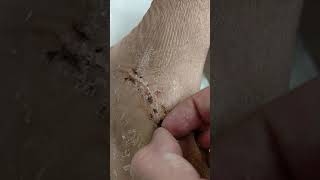 Picking scabs after cast removal #1
