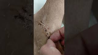 Picking scabs after cast removal #1