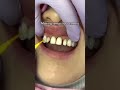 Veneer Temporaries for Peg Lateral Teeth! #veneers
