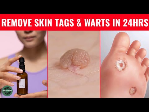 , title : 'How to Rid Skin Tags and Warts Within 24 Hours - Skin Tag Removal with Garlic & Povidone-Iodine'