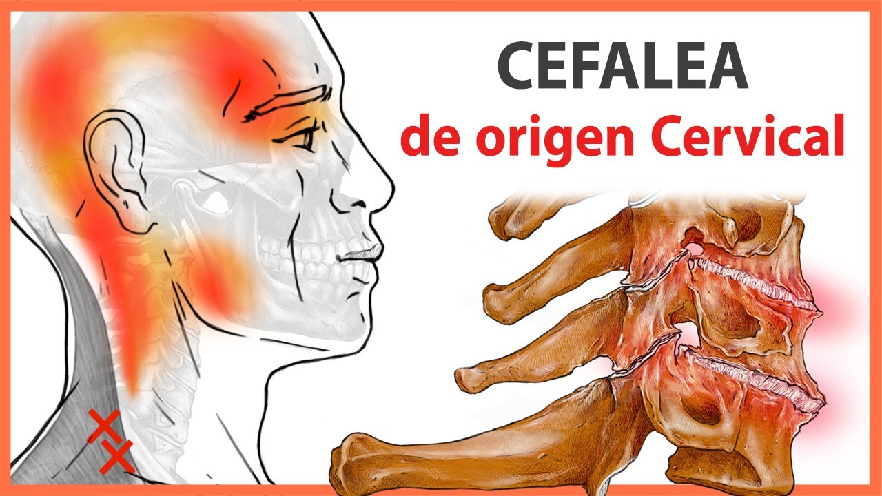 Watch 🛑 CLAVES de la CEFALEA 👉 Dolor de Cabeza de ORIGEN CERVICAL | ¿Qué es y cuáles son sus CAUSAS 😳 Now 🛑 CLAVES de la CEFALEA 👉 Dolor de Cabeza de ORIGEN CERVICAL | ¿Qué es y cuáles son sus CAUSAS 😳
