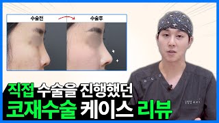 [케이스리뷰] 워나에서 코재수술 받은 케이스리뷰, 과연?  #코재수술 #케이스리뷰