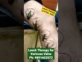 Leech Therapy For Varicoseveins Ph 9891652572 Viral Jonk Dr Aamir Atique Hijama Leech