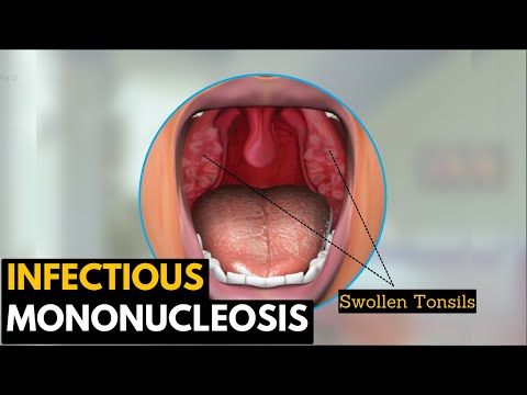 Infectious mononucleosis, Causes, Signs and Symptoms, Diagnosis and Treatment.