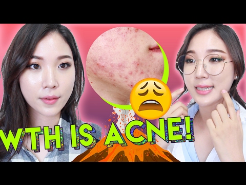 😫 What Is Acne and How To Treat Acne with Skincare Products 🌴 Liah Yoo