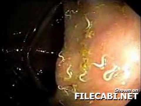 Todos os sintomas de helminths