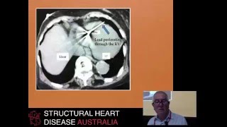 Pacemaker lead extraction – Dr Peter Brady