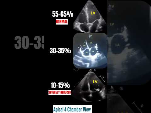 Normal to Severely Reduced Ejection Fraction on Echo | 4 Chambers view #echo