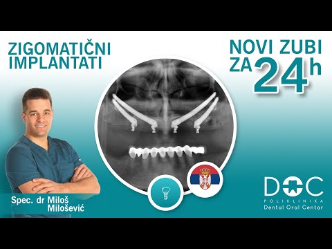 Zigomatični implantati - All on 4 tehnika - Novi zubi za 24h - Spec. dr Miloš Milošević