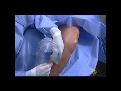 Radiofrequency Ablation of the Great & Small Saphenous Veins Training Video