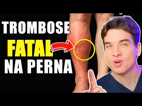 DON'T DIE FROM THROMBOSIS! | 7 PROVEN WAYS to IMPROVE CIRCULATION and PREVENT LEG CLOTS