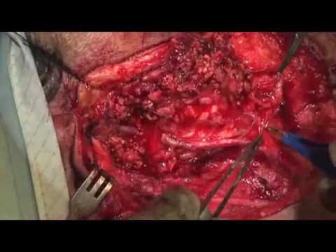 Superficial Parotidectomy