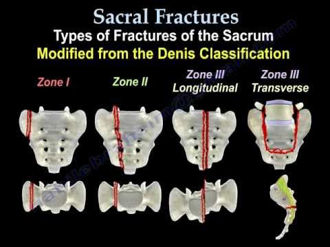 Sacral Fractures - Everything You Need To Know 