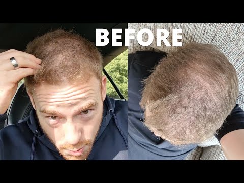 The BEST Haircut For My Thinning Hair Was The Buzz Cut...