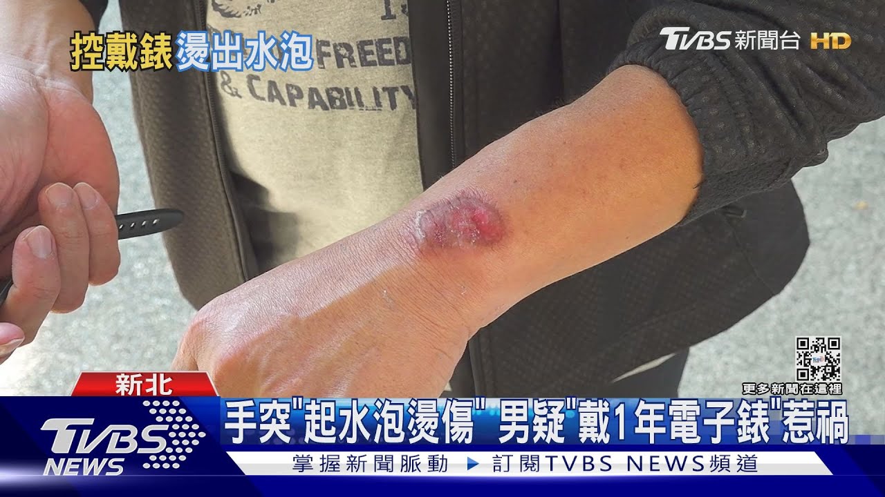 手突「起水泡燙傷」 男疑「戴1年電子錶」惹禍