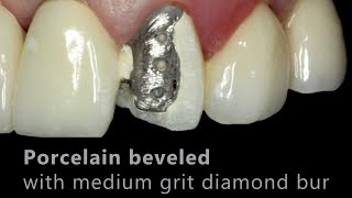 Porcelain Fused to Metal (PFM) Repair - Cosmedent, Inc.