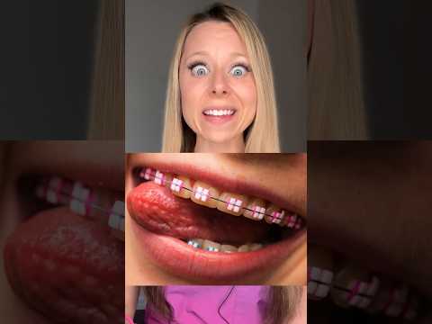 ARE LIGHTFORCE BRACES UGLY?! ORTHODONTIST REACTION AND OPINION 🦷 BRACES TIPS @Wearelightforce