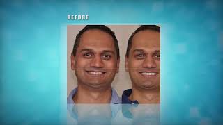 Deep Overbite Correction  with VENLAY Restorations – No Surgery, No Braces, No Drilling or  Grinding
