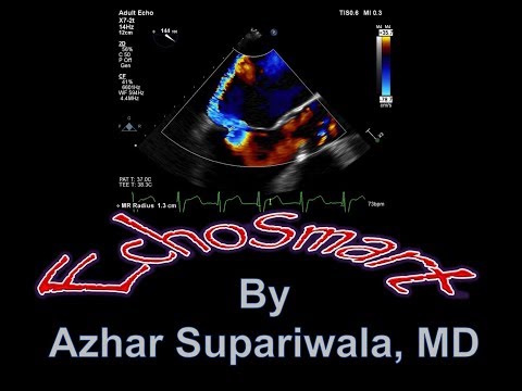 Tendyne (Abott) Transcatheter Mitral Valve Placement