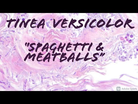 Pityriasis Versicolor/Tinea Versicolor 101: Malassezia/Pityrosporum Fungus Skin Infection