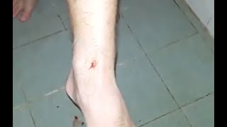 Blood Sucking Leech in My Leg in Thailand *WARNING GRAPHIC*