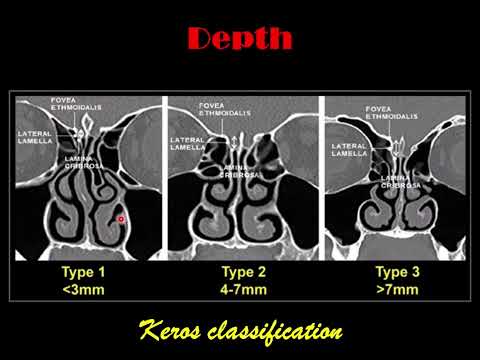 CT scan, Nose and paranasal sinus (1): Preoperative FESS checklist; Cribriform plate variations