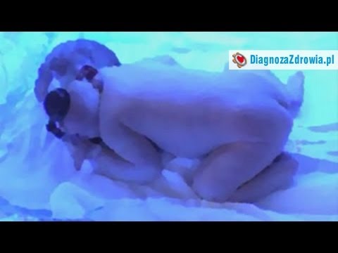Masaż stóp z deformacji koślawego wideo Operacja koślawego Buty deformacja kciuk
