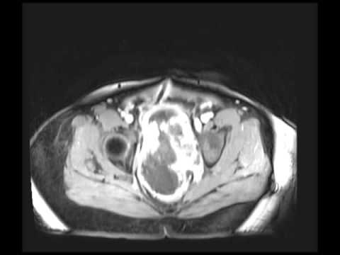 Sex vor der Prostata-Analyse Todikamp Behandlung von Prostata-Adenom