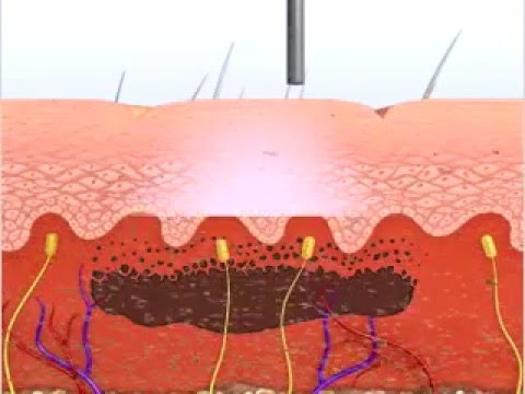 La crema chiarificando pigmentary posti Come togliere su un grembo macchie scure e la pelle resa grossolana