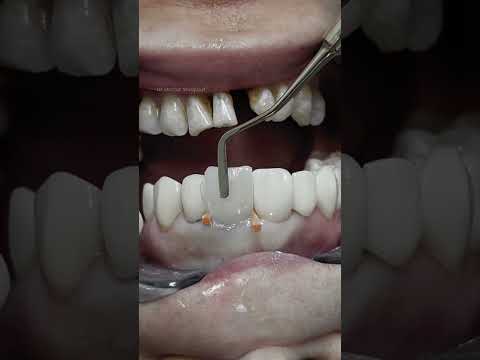 Composite veneer for discolored tooth #dental