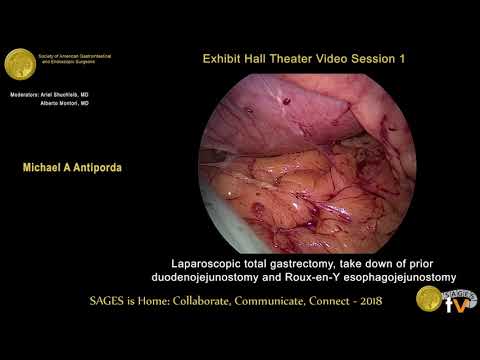 Laparoscopic total gastrectomy, takedown of prior duodenojejunostomy and RNY esophagojejunostomy from the SAGES Video Library