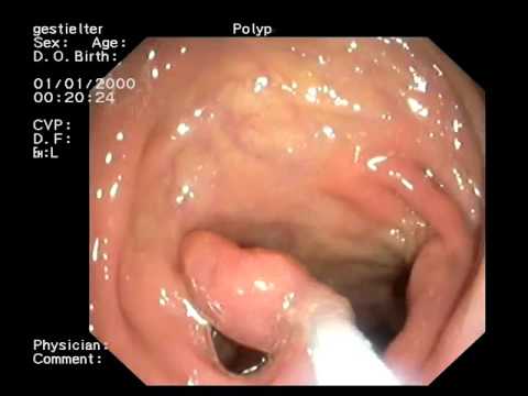 Ob Sie mit Prostatitis masturbieren Was es ist TRUS Prostata und wie es gemacht wird