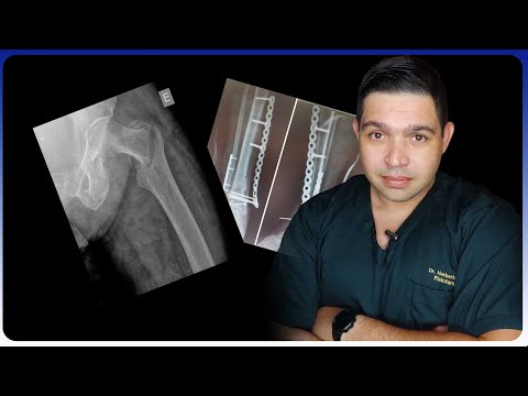 CUIDADO PERNA INCHADA APÓS FRATURA PODE NÃO SER NORMAL